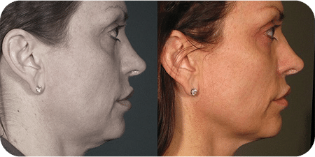 Ultrassom Estético e Microfocado - Salvador 21 DSC04262-scaled-1UKLTRASSOM