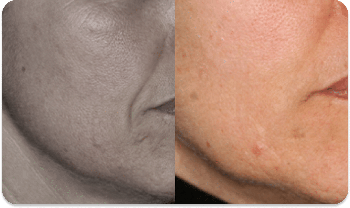 DSC04779 scaled 1 1 MICROAGULHAMENTO