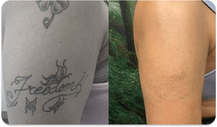 DSC04779 scaled 1 1 REMOCAO TATUAGEM