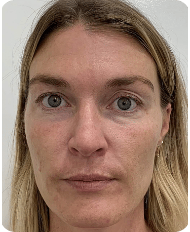 Eletrocautério | Remoção de Lesões Cutâneas - São Paulo 26 DSC04779-scaled-1 (1)ELETRO