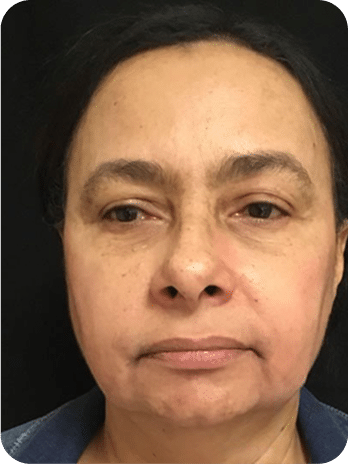 Peelings Químicos & Físicos - Rio de Janeiro 22 DSC04779-scaled-1 (1)PEELINGS