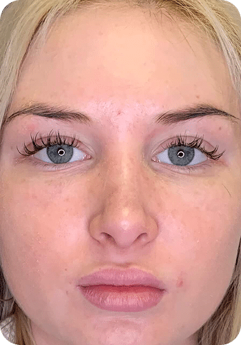 PRP & PRF | Plasma Rico em Plaquetas ou Fibrina - Goiânia 26 DSC04779-scaled-1 (1)PRP