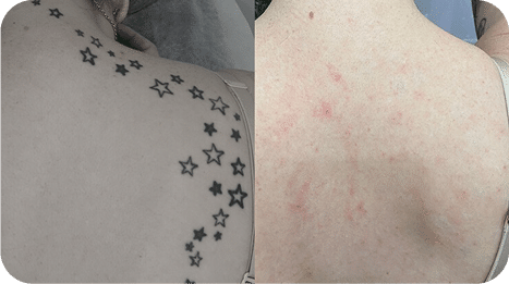 Remoção de Tatuagem com Laser - Goiânia 24 DSC04779-scaled-1 (1)TATTOO-1