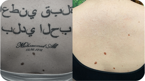 Remoção de Tatuagem com Laser - Goiânia 23 DSC04779-scaled-1 (1)TATTOO