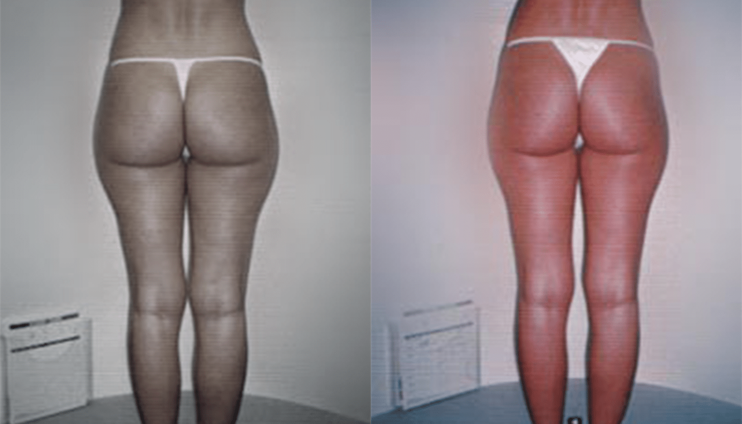 Endermoterapia-1