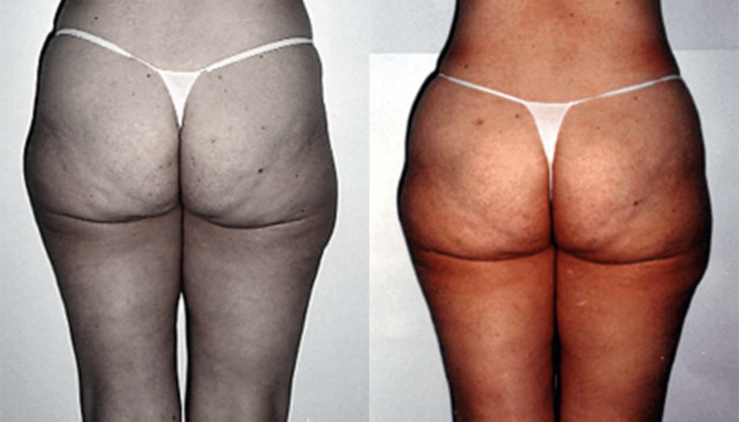 Endermoterapia-2