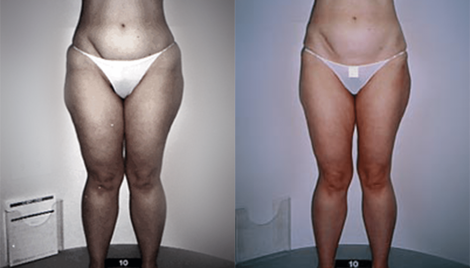 Endermoterapia-3