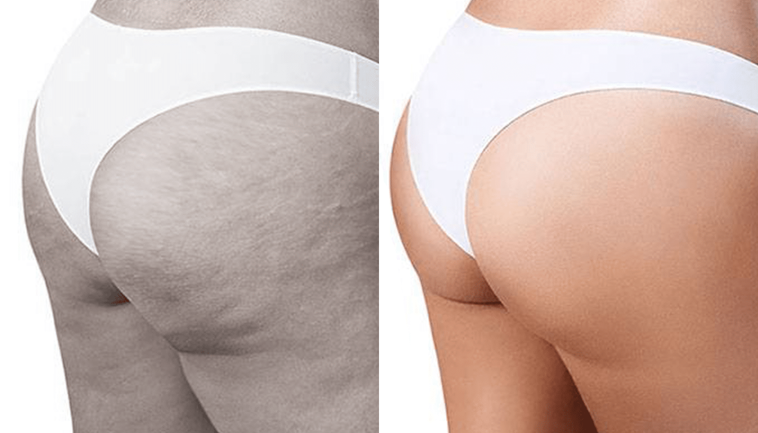 Endermoterapia-4