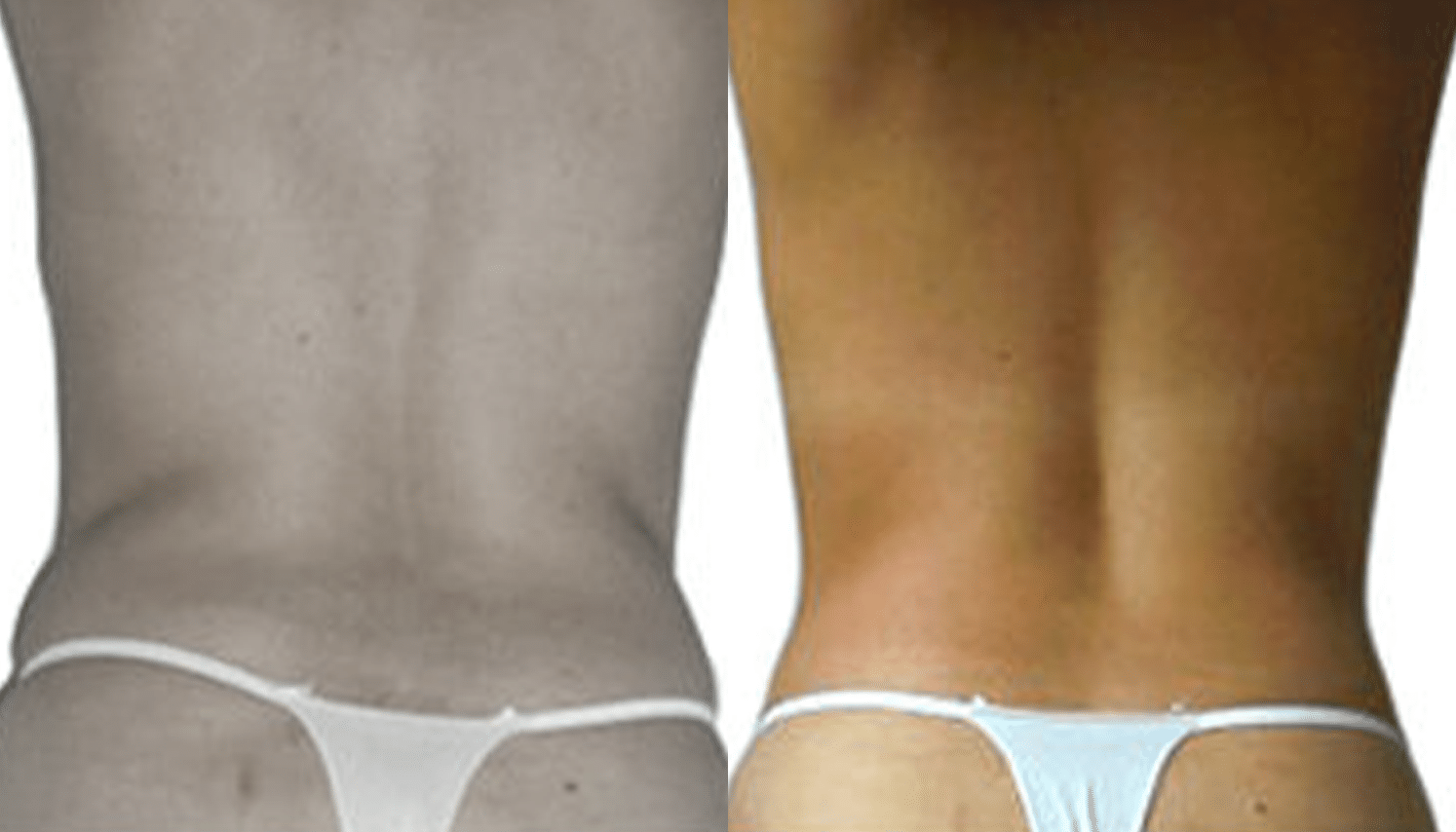 Endermoterapia-5