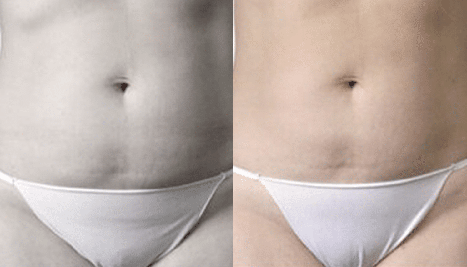 Endermoterapia-6