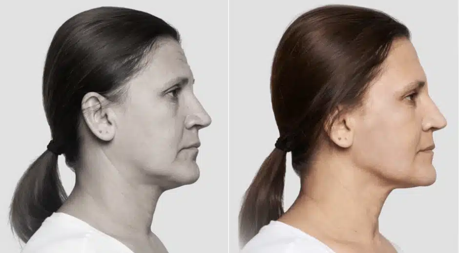 Fios-de-sustentacao-7