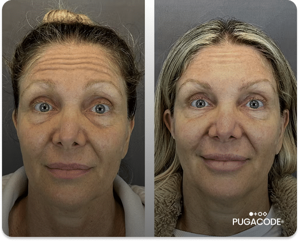 Group 1427 preenchimeto facial