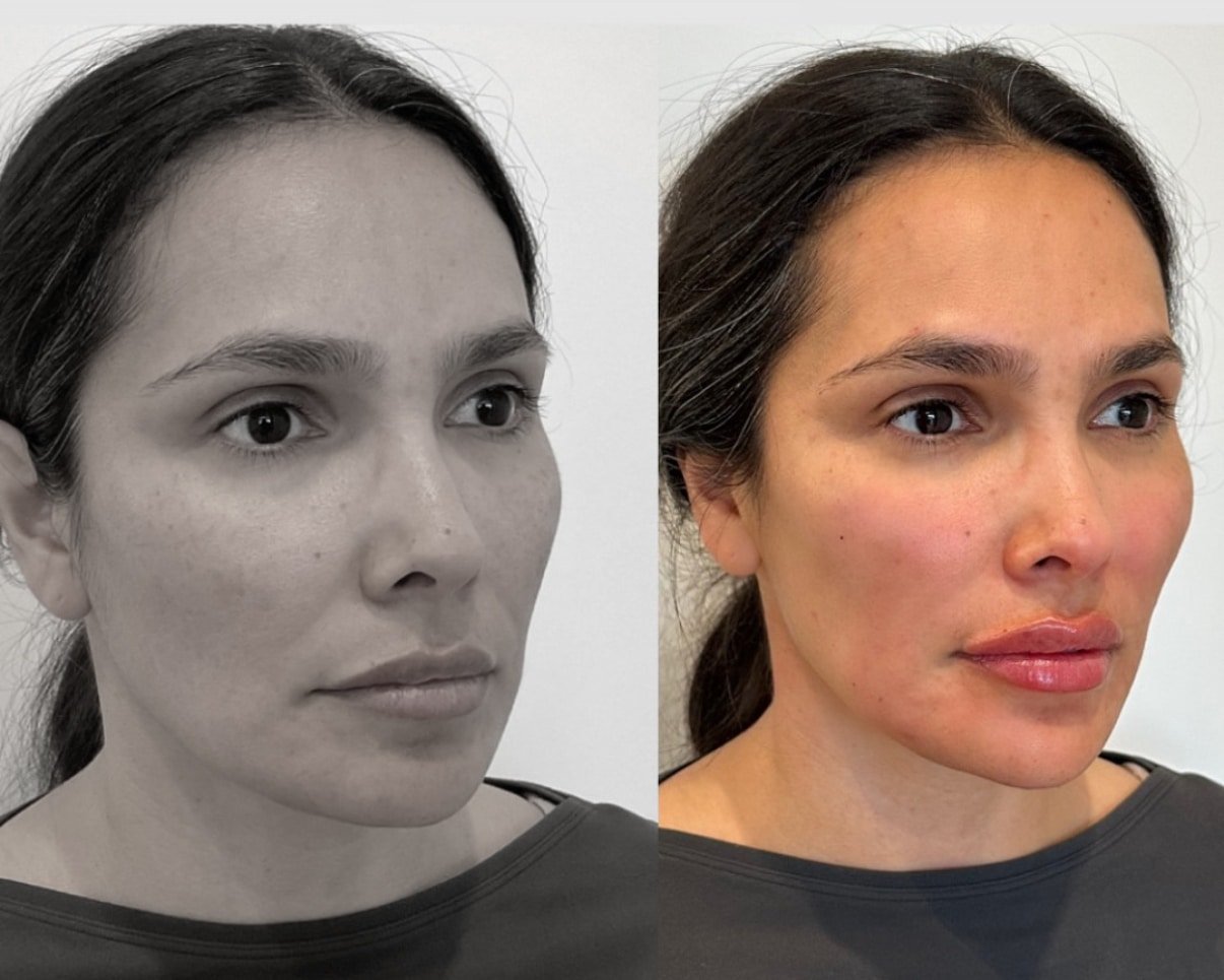 Hamonizacao-facial-2