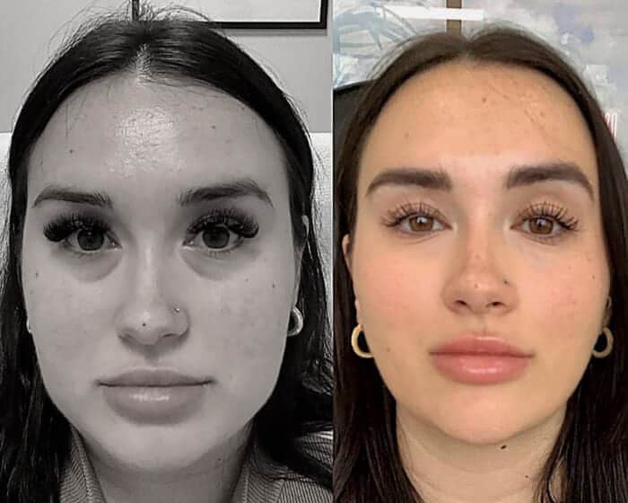 Hamonizacao-facial-6