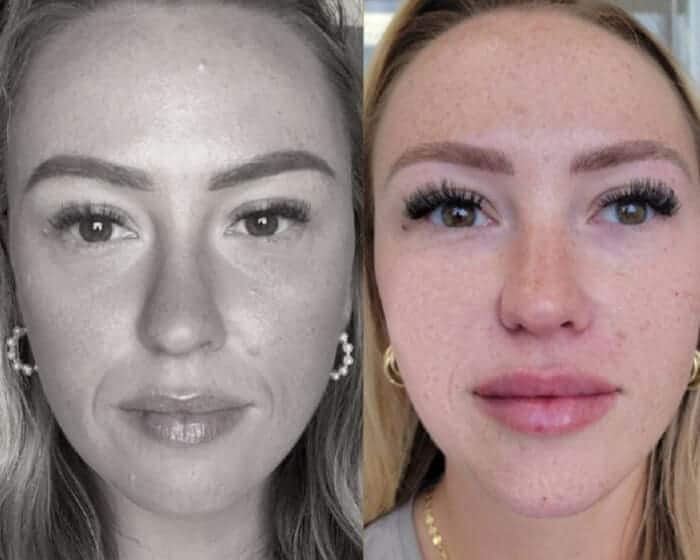 Hamonizacao-facial-9