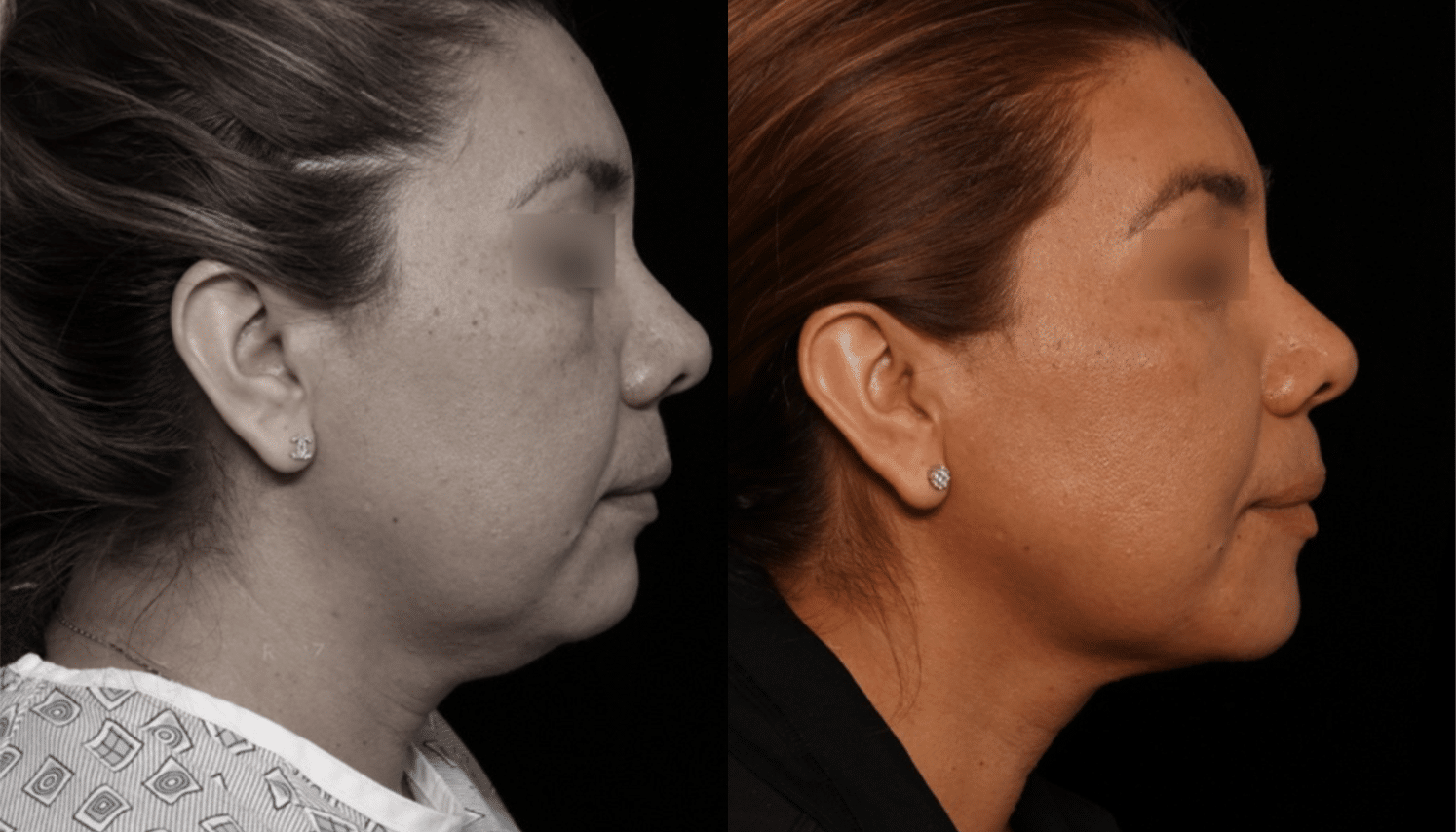 Hidrolipoclasia-3