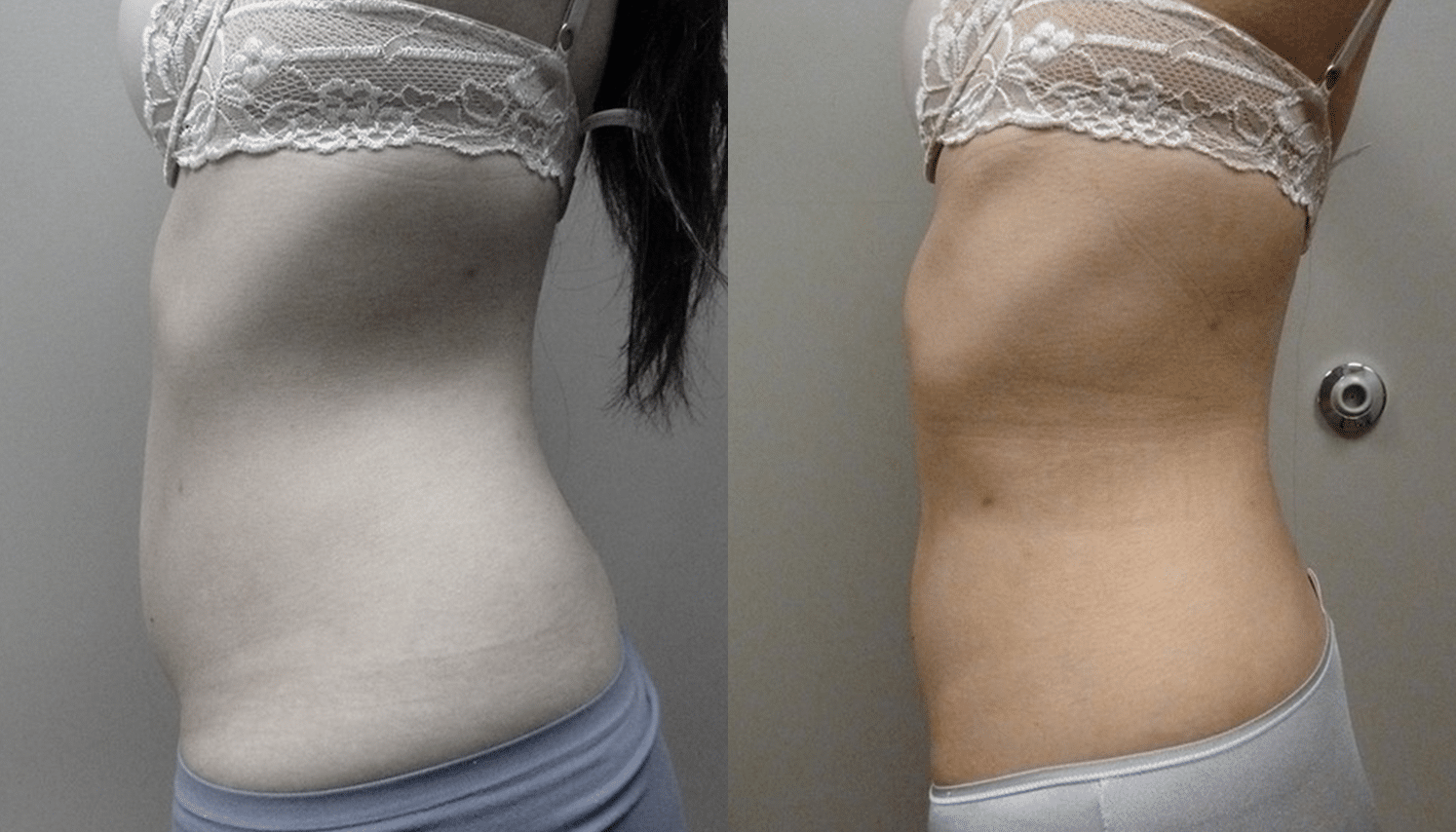 Hidrolipoclasia-4