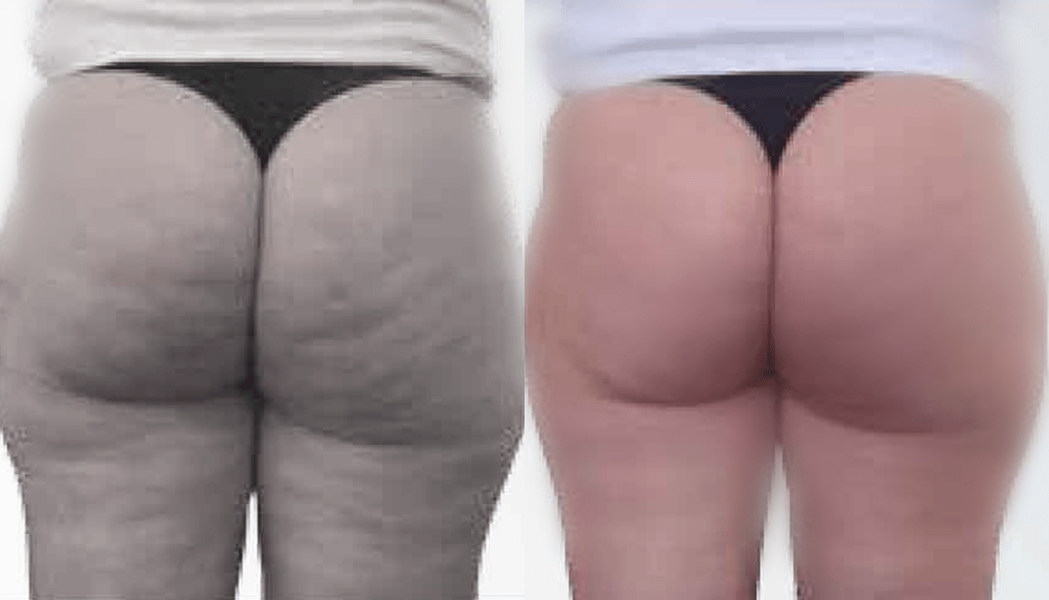 Injeção Intramuscular-3