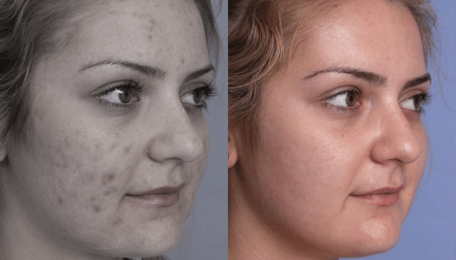 LED Terapia | Fototerapia Facial - Rio de Janeiro 7 LED Terapia-1