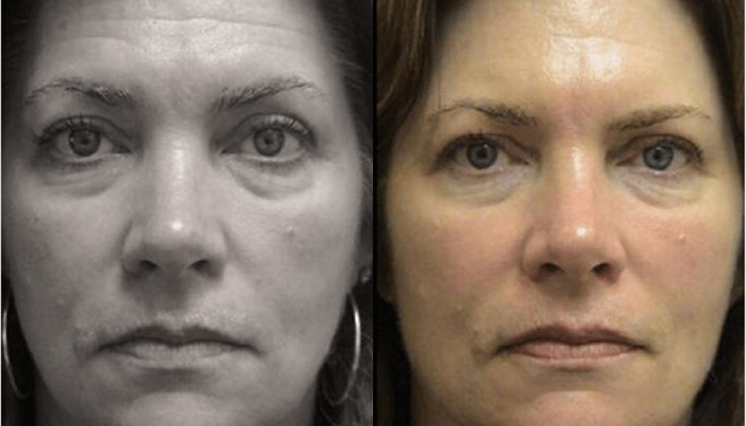 LED Terapia | Fototerapia Facial - Rio de Janeiro 9 LED Terapia-3