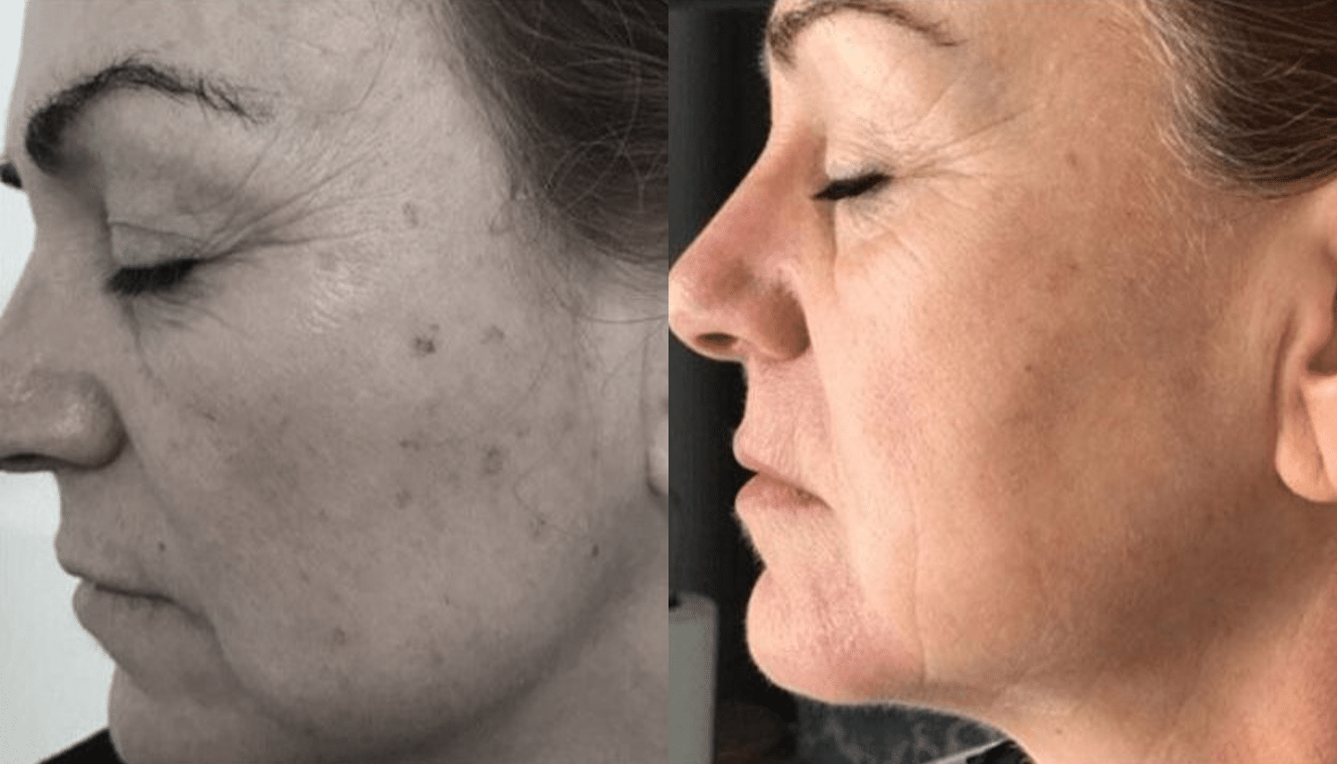 LED Terapia | Fototerapia Facial - Rio de Janeiro 10 LED Terapia-4