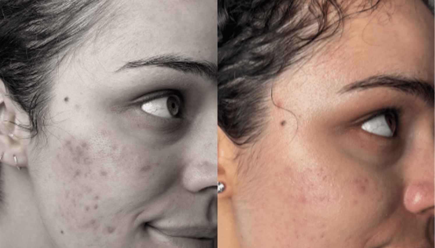 LED Terapia | Fototerapia Facial - Rio de Janeiro 11 LED Terapia-5