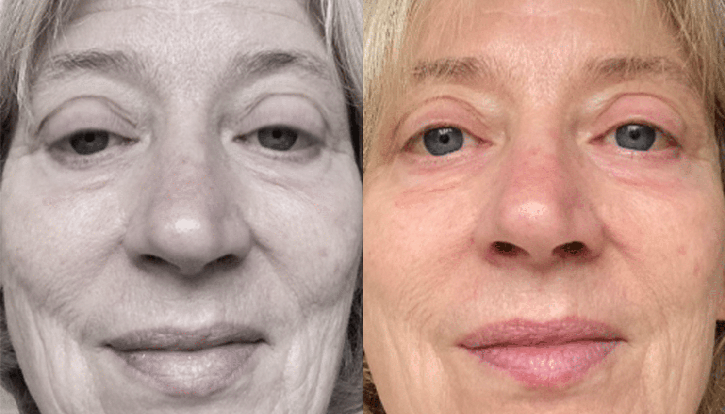 LED Terapia | Fototerapia Facial - Rio de Janeiro 12 LED Terapia-6