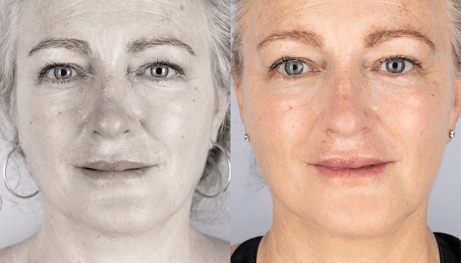 LED Terapia | Fototerapia Facial - Rio de Janeiro 14 LED Terapia-8