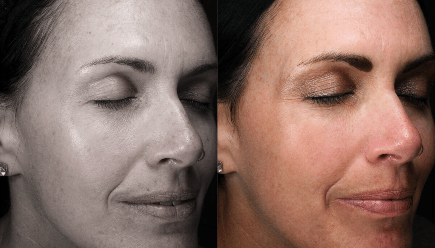 Lavieen | Laser de BB Glow Coreano - Florianópolis 8 Lavieen-1