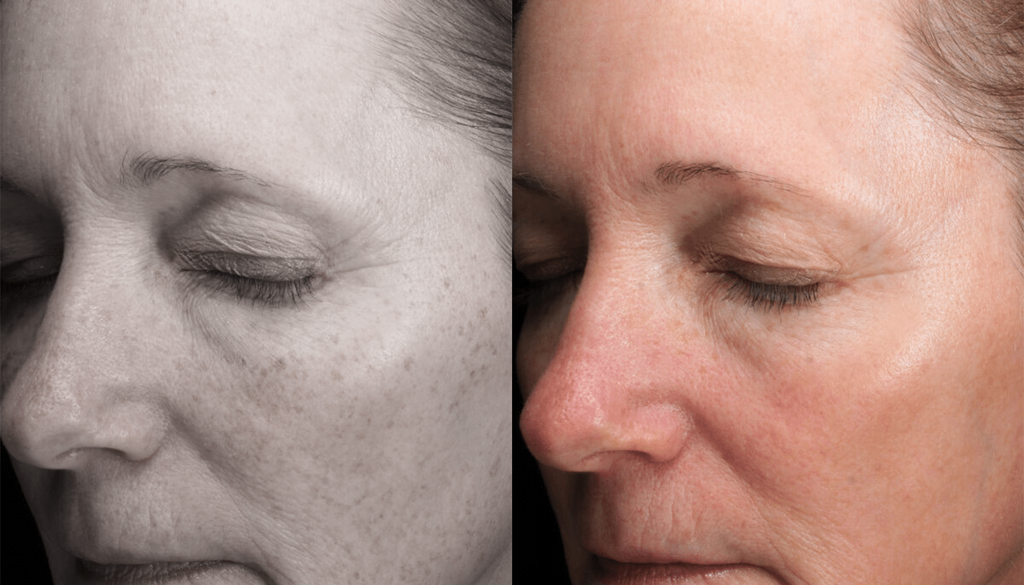 Lavieen | Laser de BB Glow Coreano - Florianópolis 9 Lavieen-2