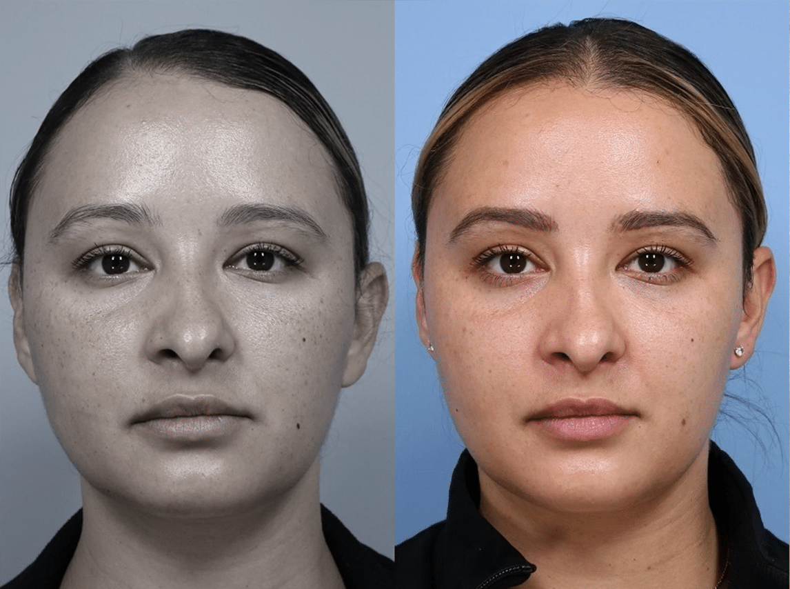 Lavieen | Laser de BB Glow Coreano - Florianópolis 10 Lavieen-3