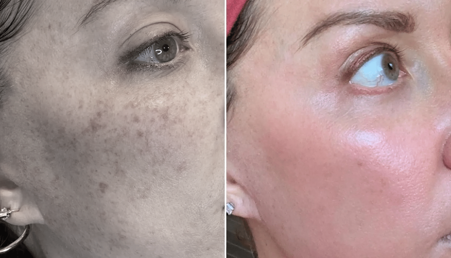 Lavieen | Laser de BB Glow Coreano - Florianópolis 11 Lavieen-4