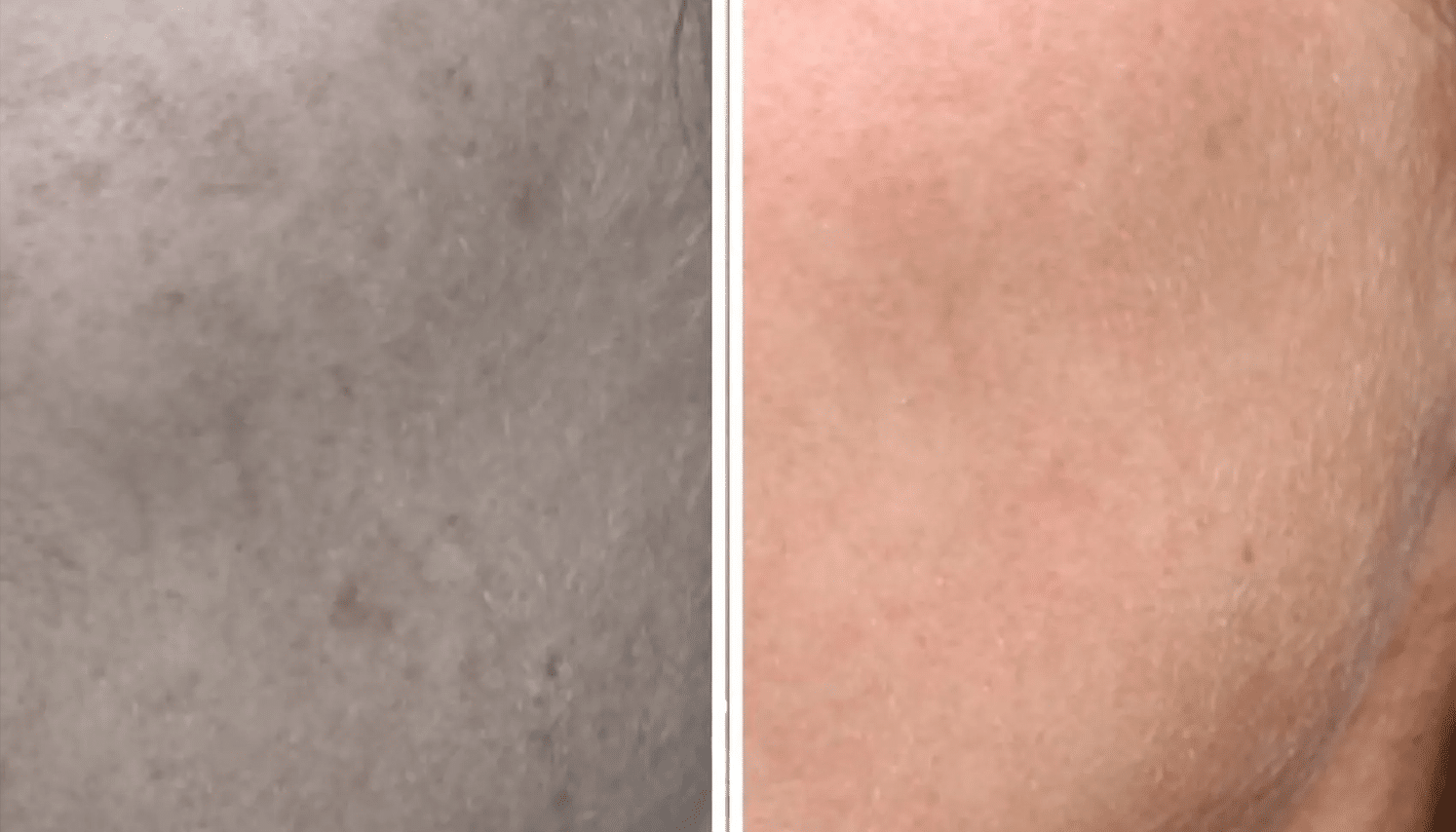 Lavieen | Laser de BB Glow Coreano - Florianópolis 12 Lavieen-5