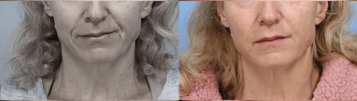 Lavieen | Laser de BB Glow Coreano - Florianópolis 13 Lavieen-6