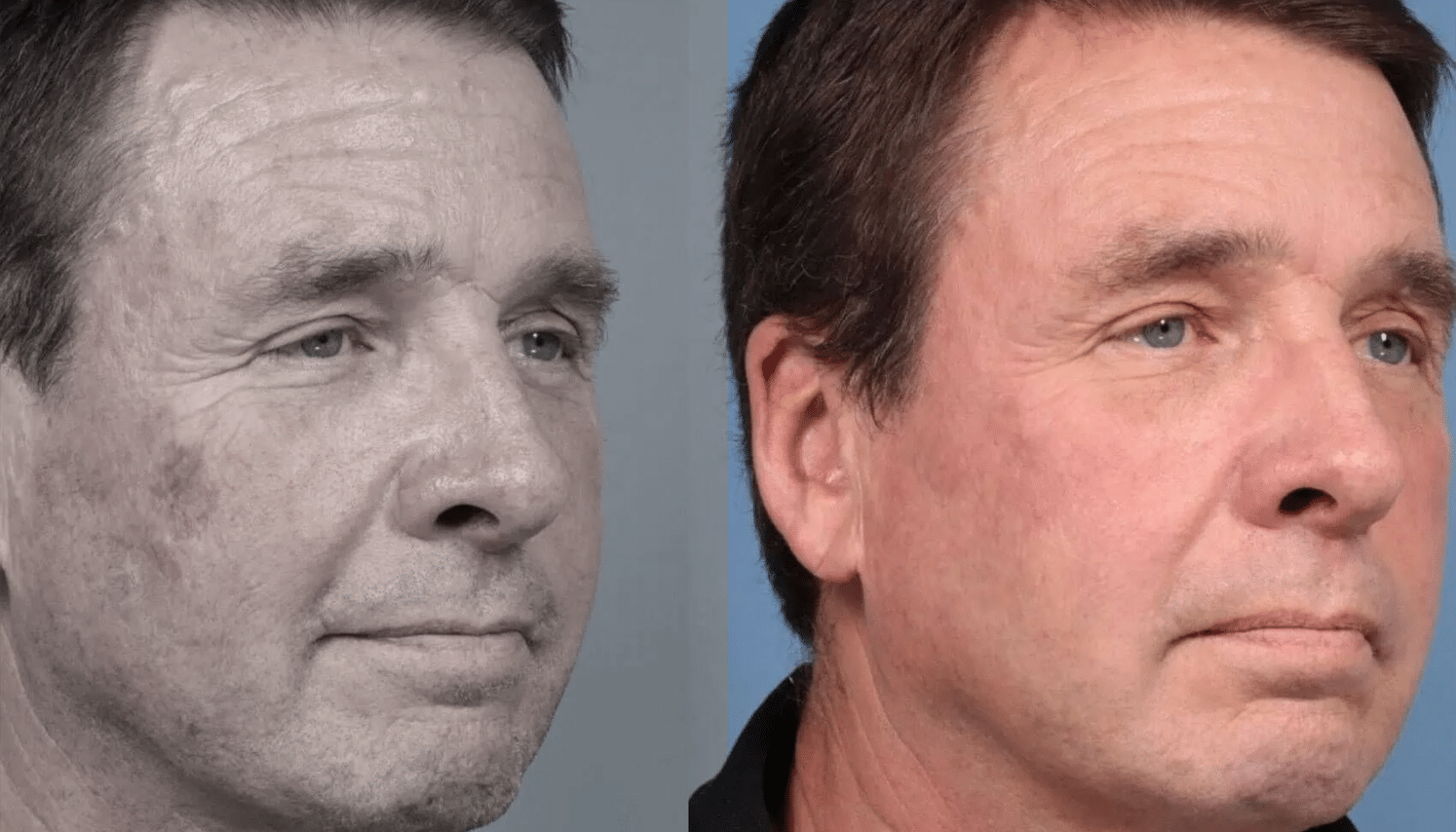 Lavieen | Laser de BB Glow Coreano - Florianópolis 14 Lavieen-7