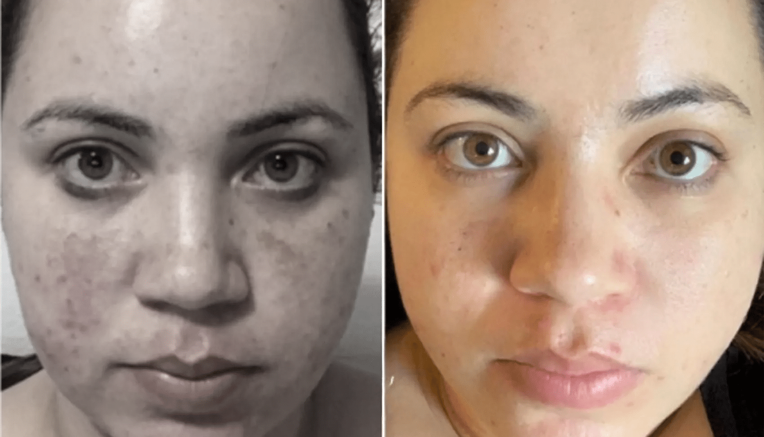 Lavieen | Laser de BB Glow Coreano - Florianópolis 15 Lavieen-8