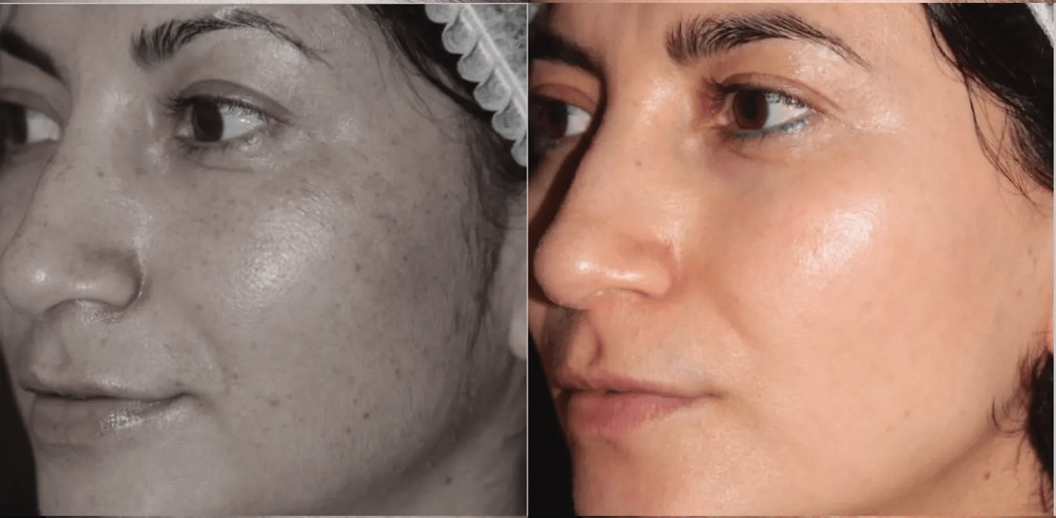 Lavieen | Laser de BB Glow Coreano - Florianópolis 16 Lavieen-9