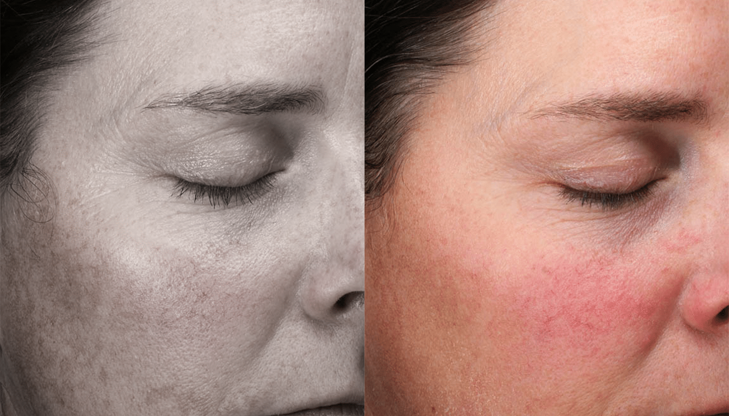 Lavieen | Laser de BB Glow Coreano - Florianópolis 7 Lavieen