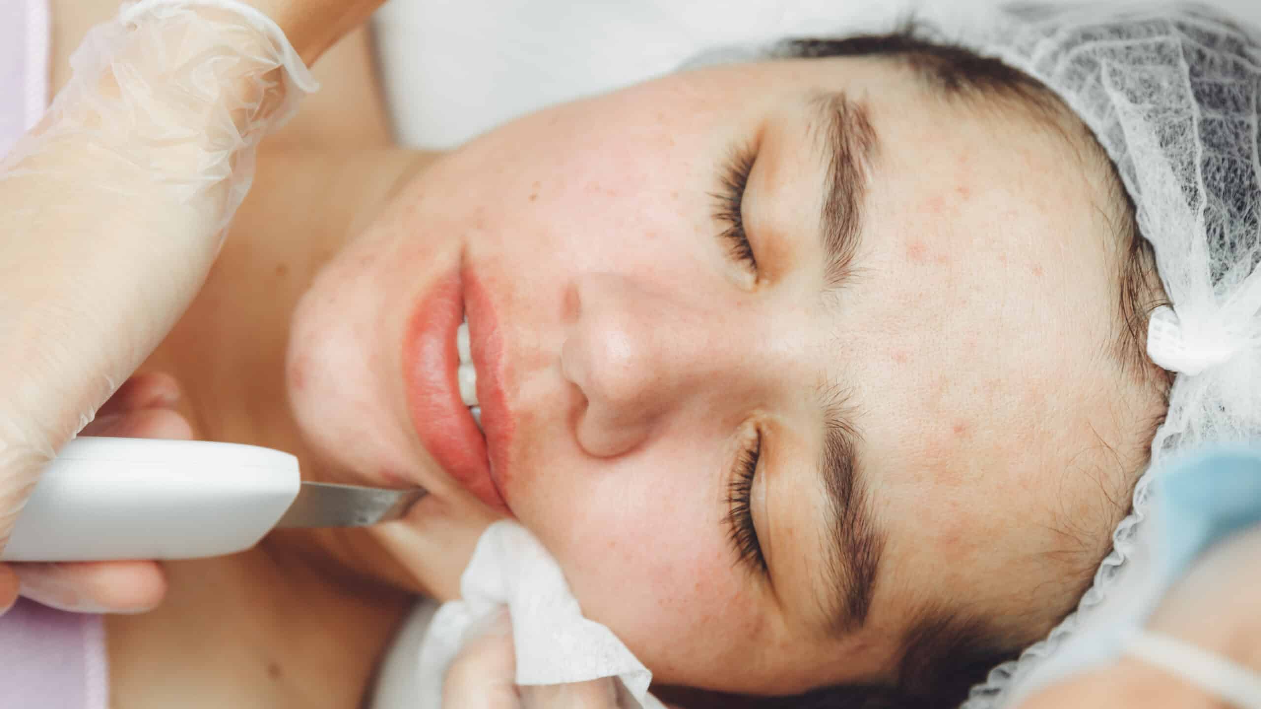 Ultrasonic cosmetic scrubber. Facial cavitation procedure. Salon skin care procedure. Professional hardware peeling. Acne removal. contaminated person