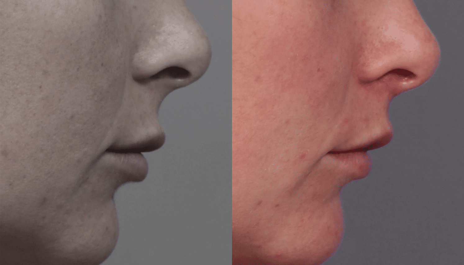Lip Lifting-4
