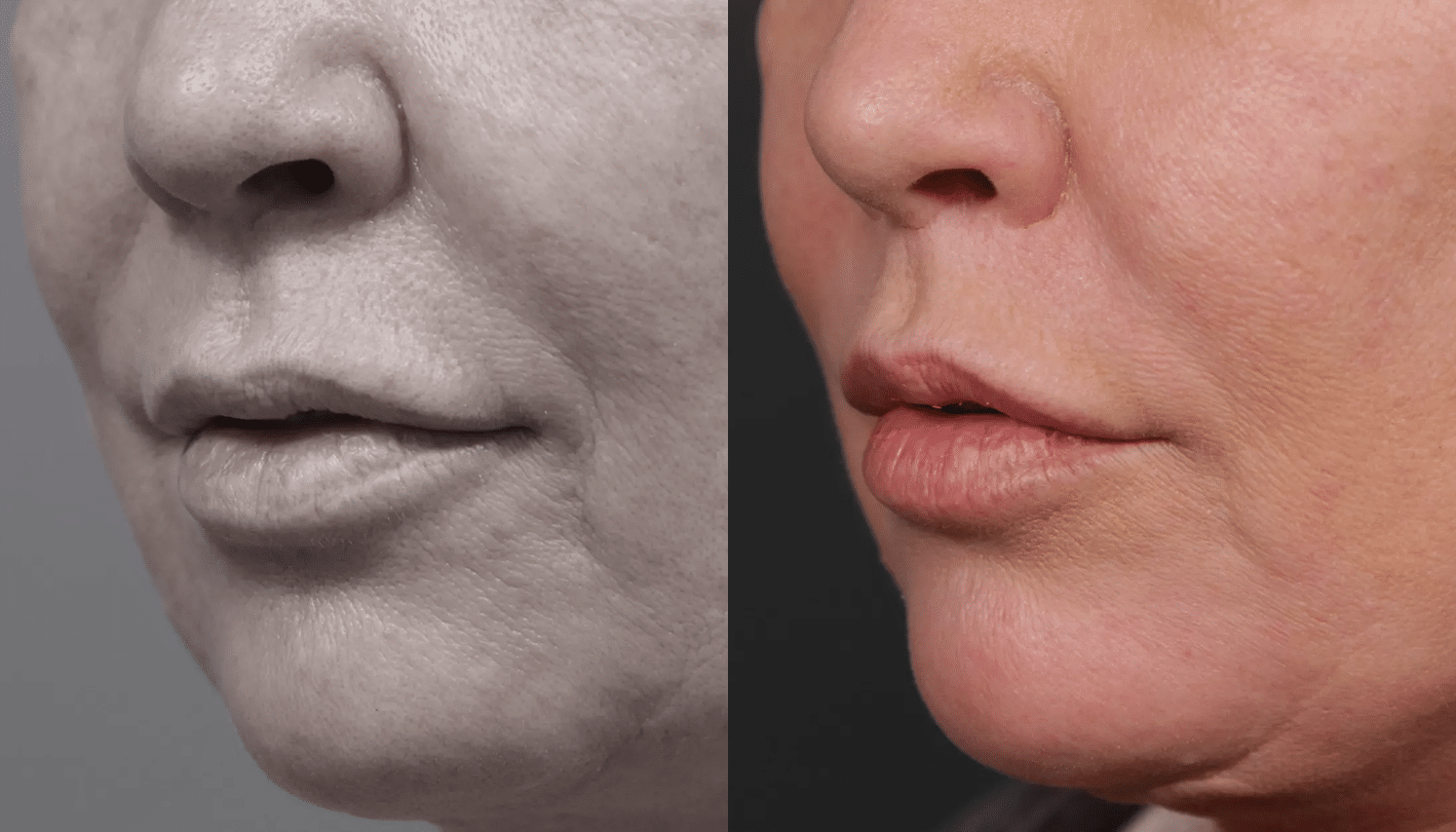 Lip Lifting-5