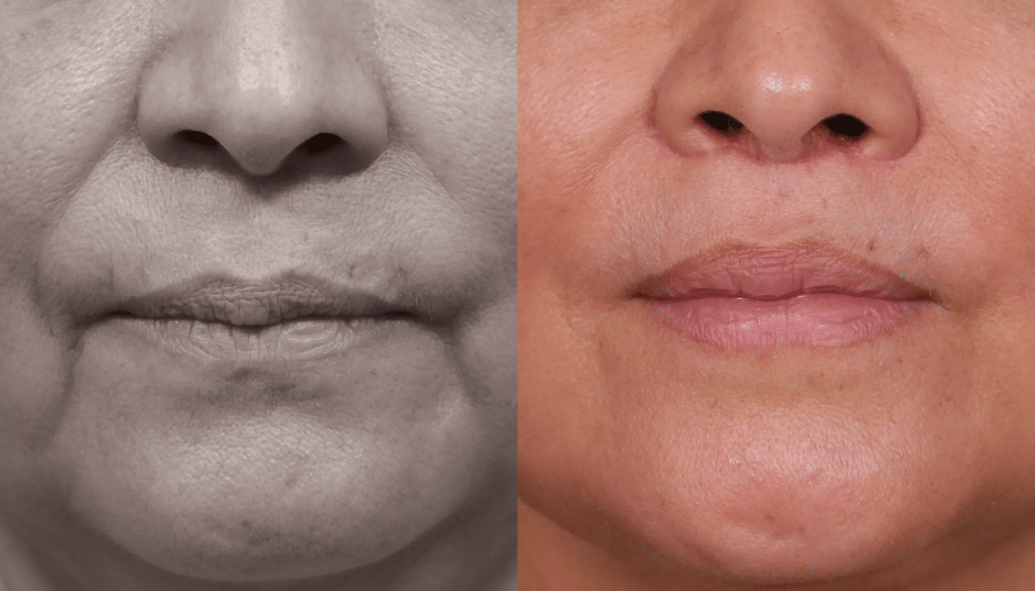Lip Lifting-6