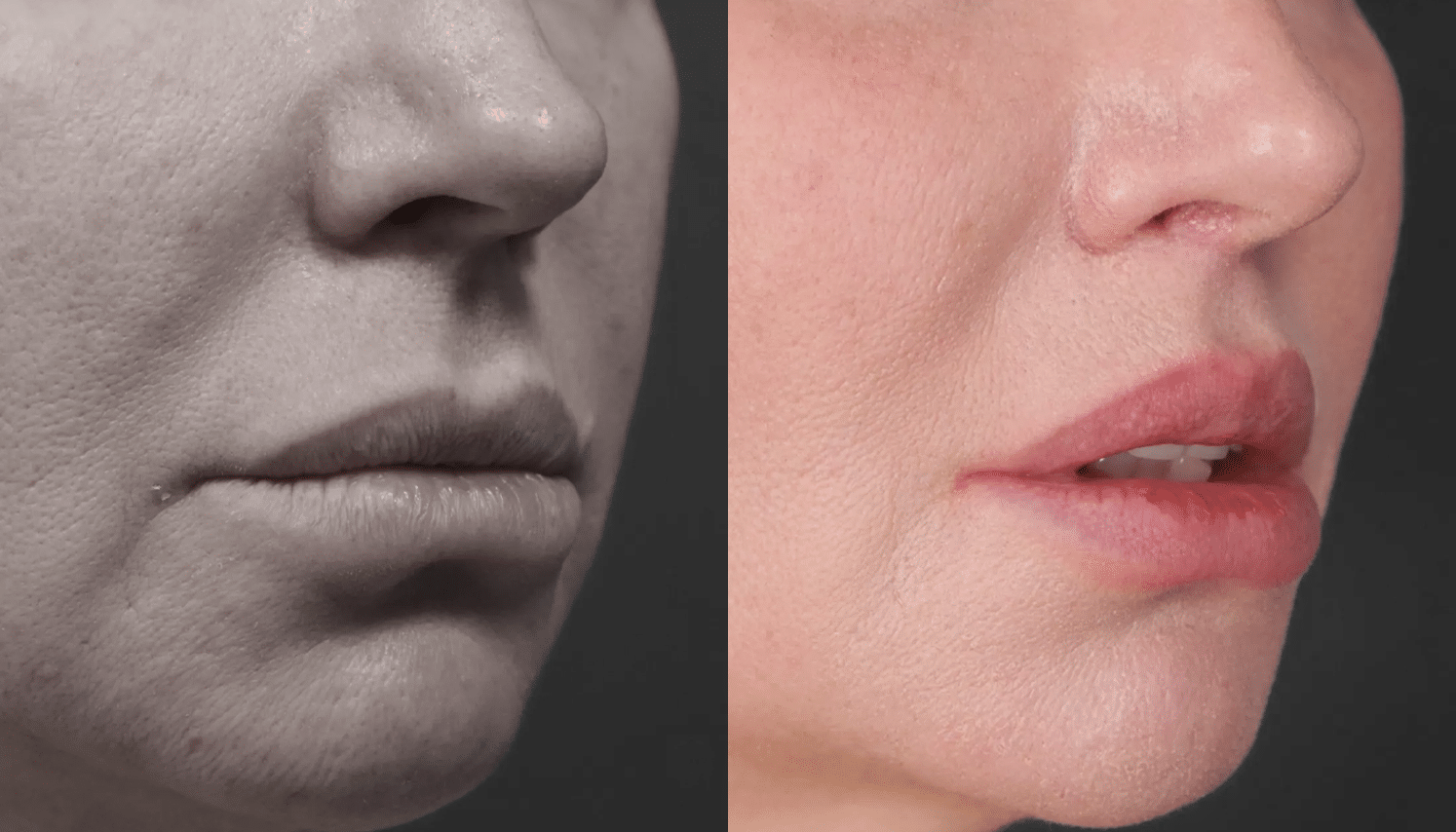 Lip Lifting-8