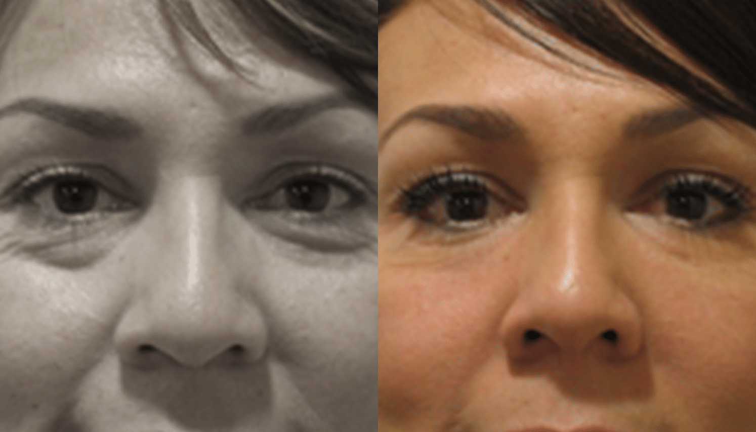 Mesoterapia-2