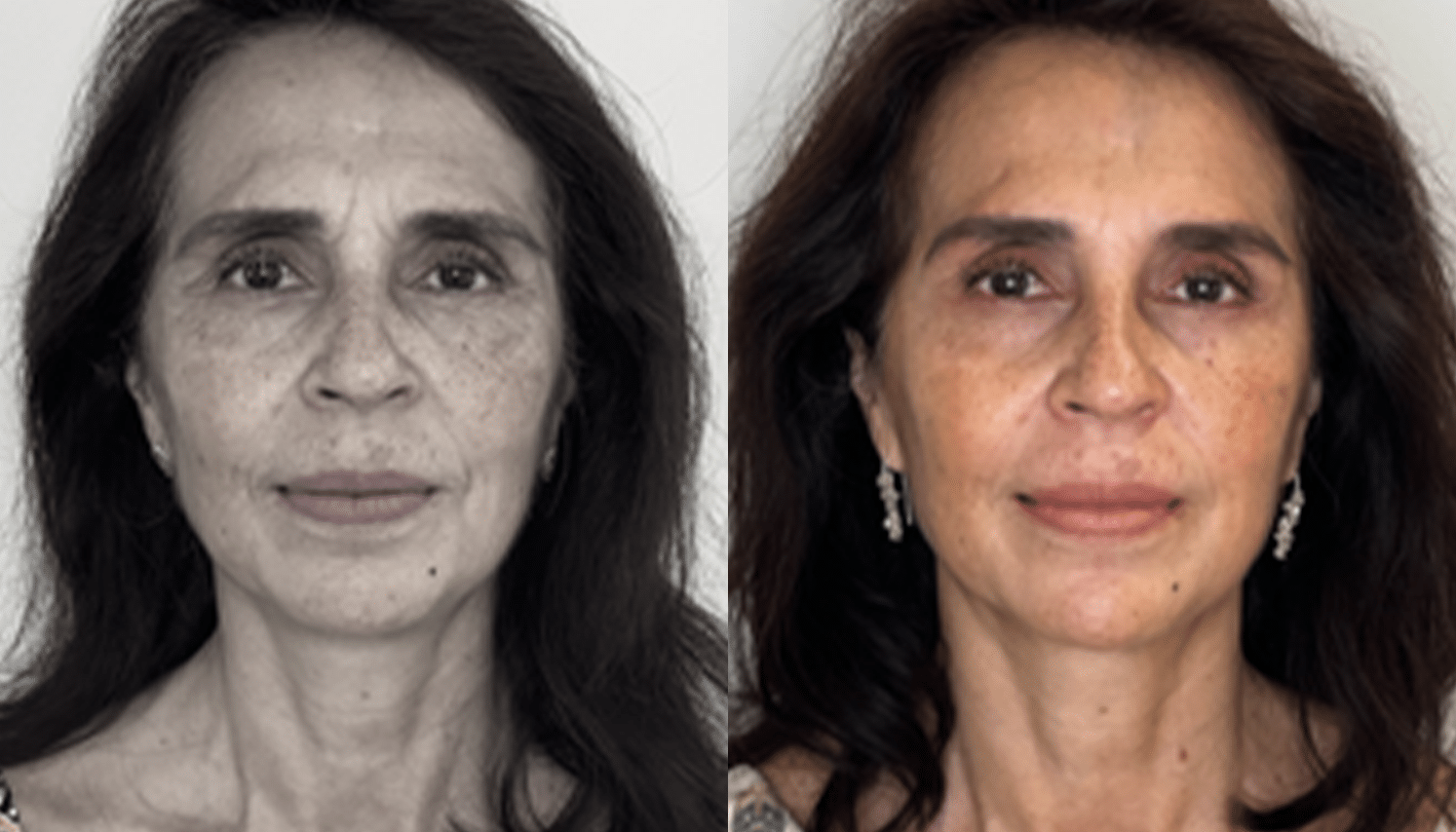 Mesoterapia-3