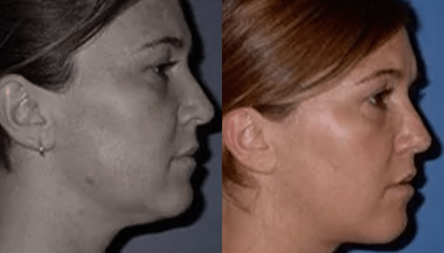 Mesoterapia-4