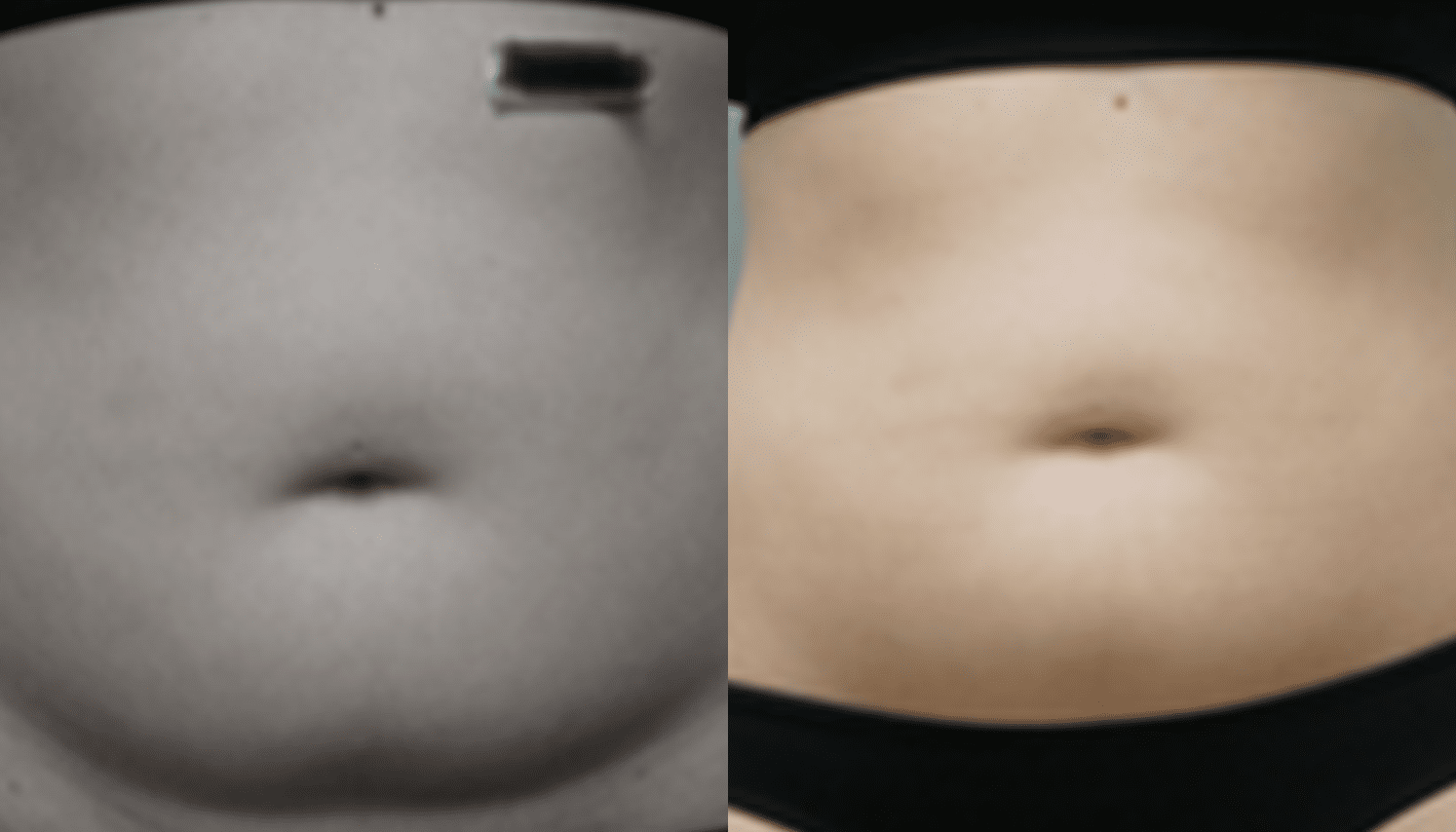 Mesoterapia-5