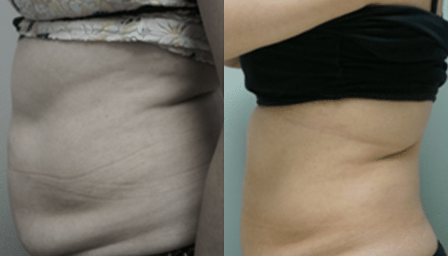 Mesoterapia-6