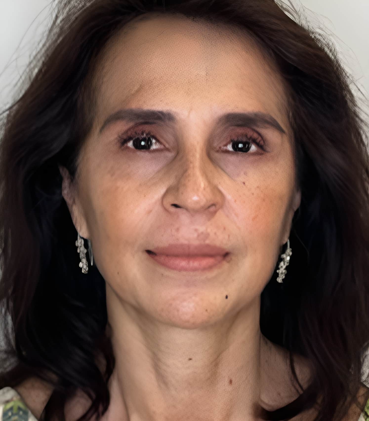 Mesoterapia-depois