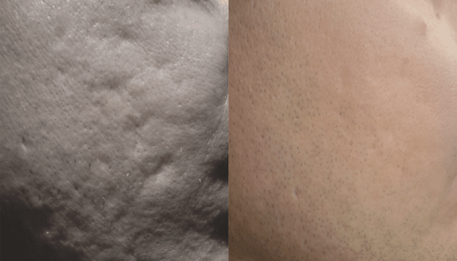 Microagulhamento | Derma Pen & Roller 5 Microagulhamentos-1